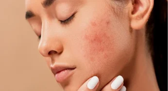 Tips to Overcome Acne Scars for Smoother Skin